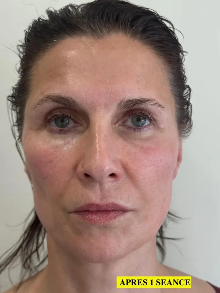Résultat radiofréquence visage – Peau raffermie et traits redessinés
