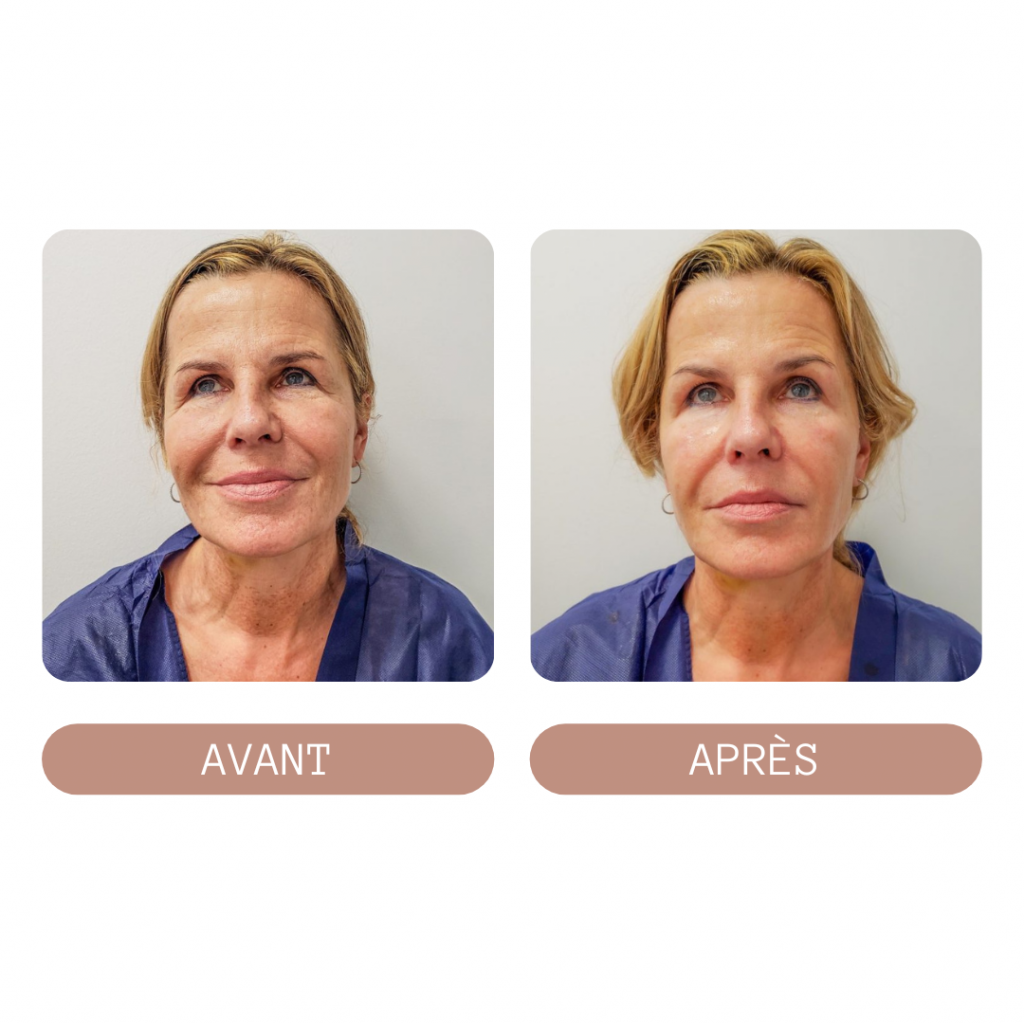Avant et après l'application de la cosmétologie sur une femme âgée.