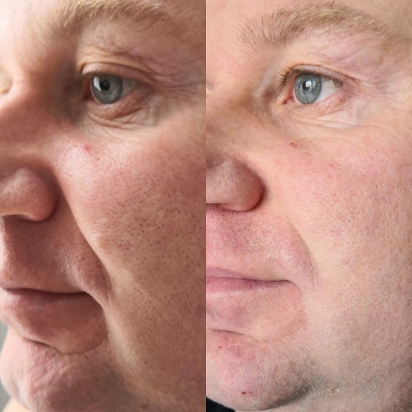 Avant et après : homme appliquant le masque de peeling au carbone V.