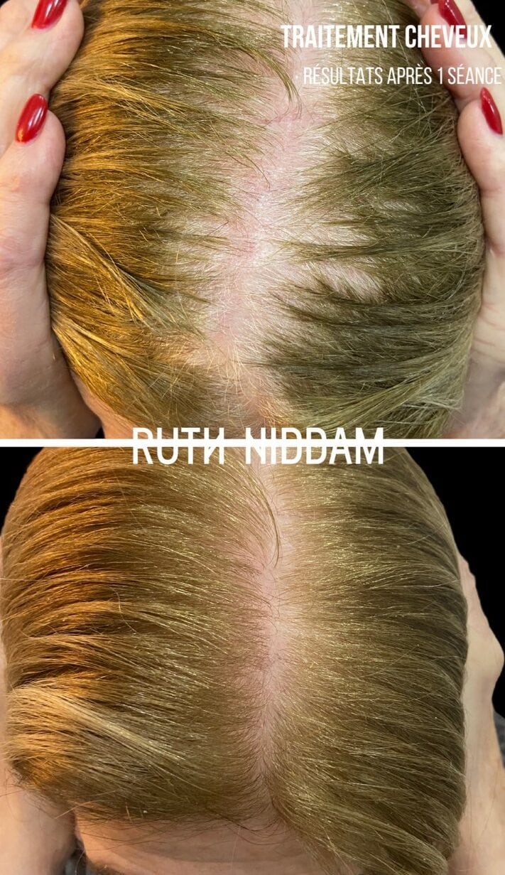 Chute de Cheveux : Solution JET PEEL