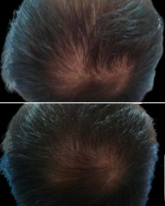 avant-apres-jetpeelcheveux-3.png