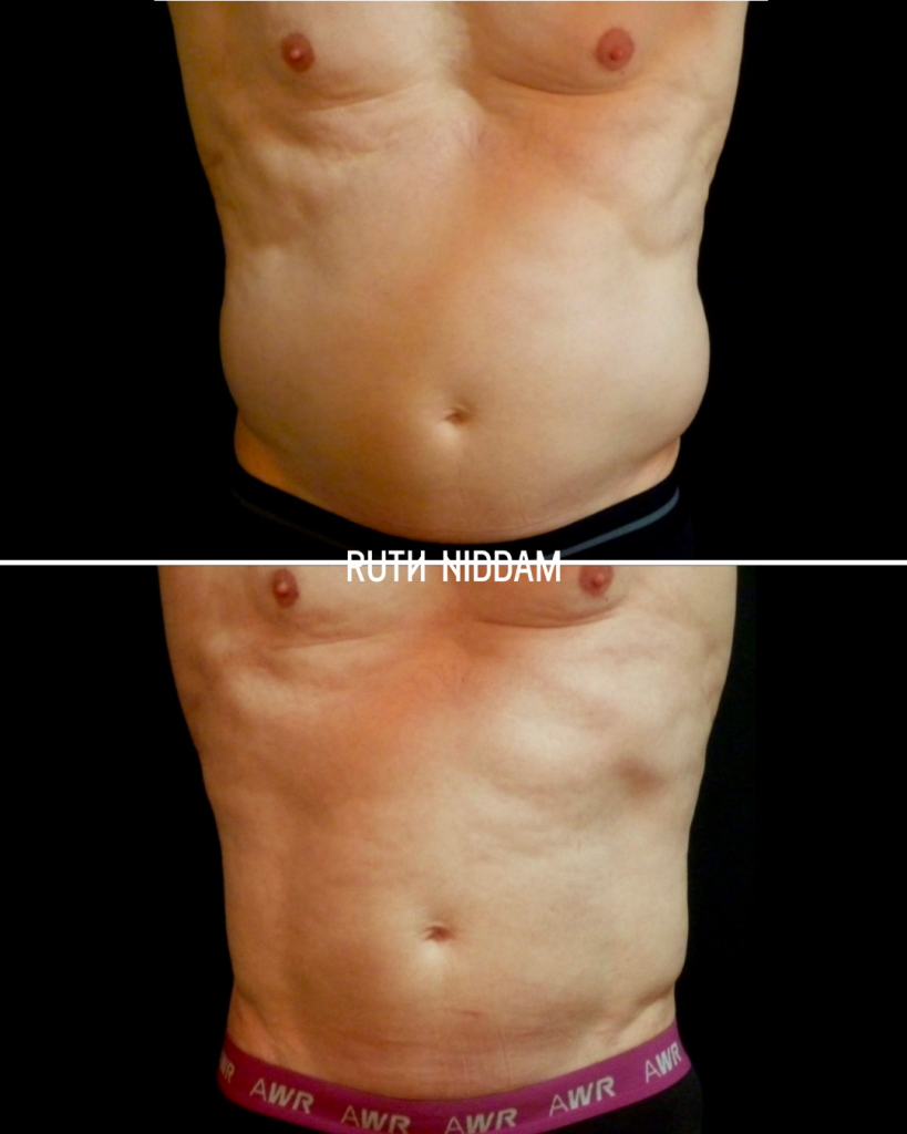 Résultat radiofréquence + ultrasons ventre homme – Silhouette affinée et gain de fermeté