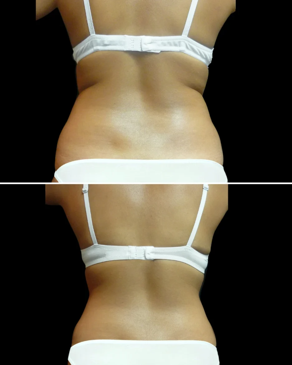 Remodelage du dos sans chirurgie – Résultat Accent Prime™ Paris