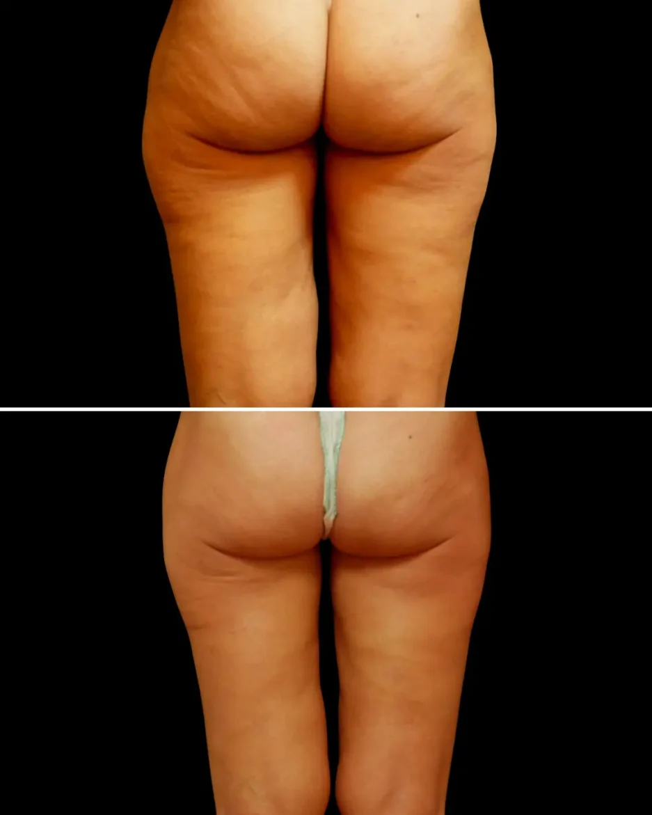 Accent Prime™ cuisses – Réduction de la cellulite après 5 séances