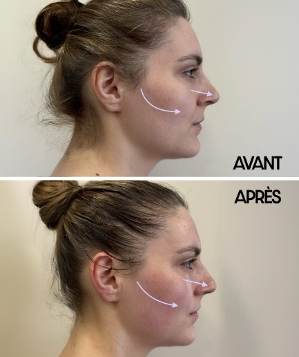 AVANT _ APRES KOBIDO-1