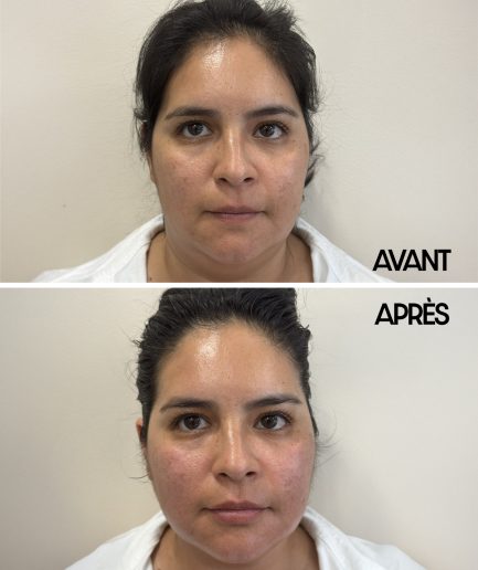 AVANT _ APRES KOBIDO-2