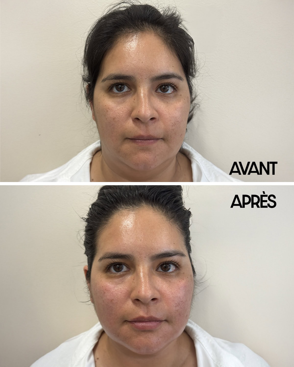 Soin signature visage avant apr&egrave;s Ruth Niddam