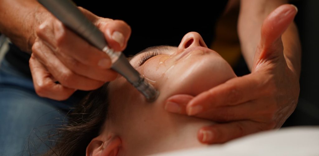 Séance de microneedling du visage pour atténuer les cicatrices d’acné