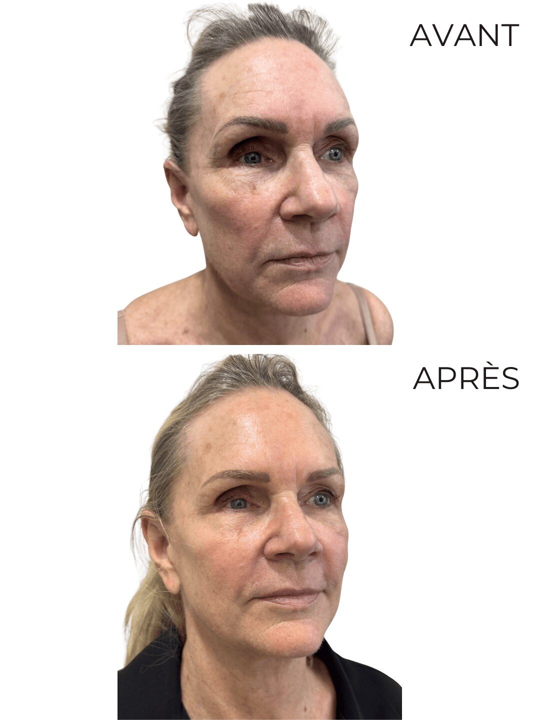 Avant après Soin Signature Walking on the Skin