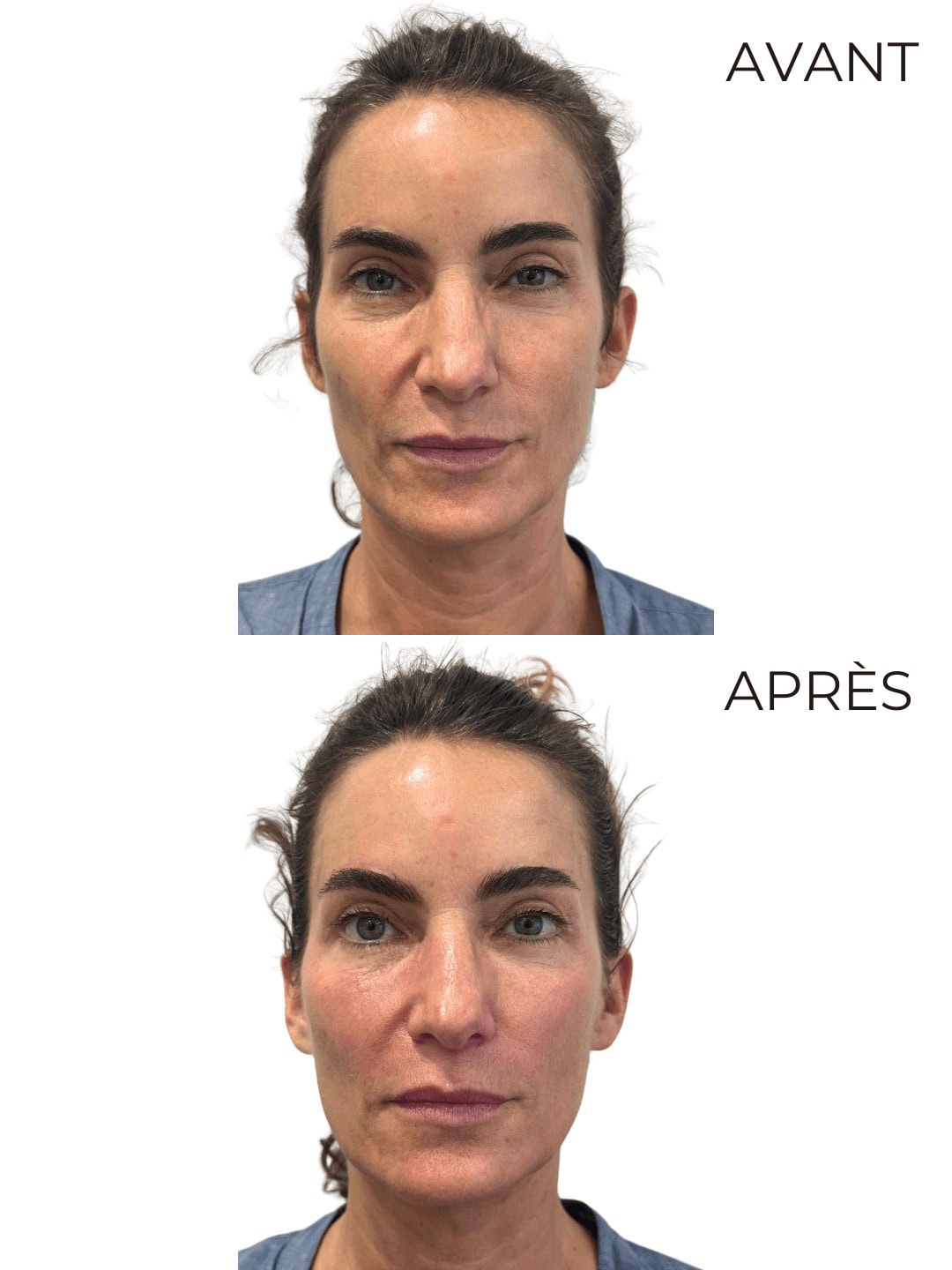 Résultat Kobido — Éclat & tonicité