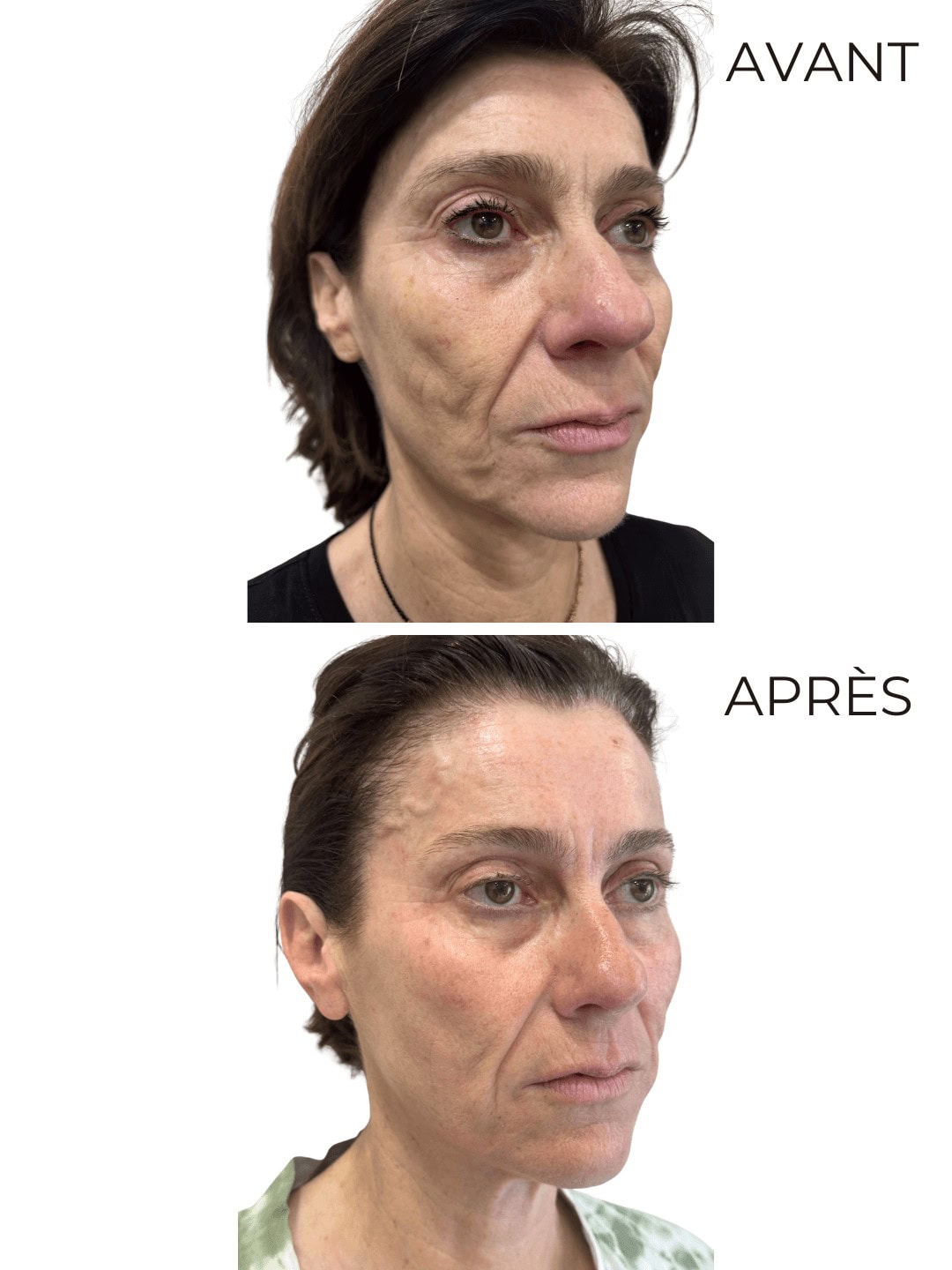 Résultat Kobido — Effet liftant naturel